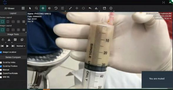 Tuyên Quang: Đi khám răng, cụ ông 70 tuổi rùng mình khi bác sĩ thông báo “chìa” hình ảnh sán lúc nhúc toàn thân - Ảnh 4. Tuyên Quang: Đi khám răng, cụ ông 70 tuổi rùng mình khi bác sĩ thông báo “chìa” hình ảnh sán lúc nhúc toàn thân - Ảnh 4.