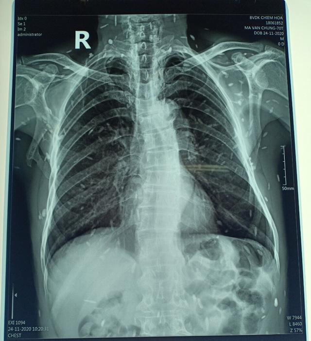 Tuyên Quang: Đi khám răng, cụ ông 70 tuổi rùng mình khi bác sĩ thông báo “chìa” hình ảnh sán lúc nhúc toàn thân - Ảnh 2. Tuyên Quang: Đi khám răng, cụ ông 70 tuổi rùng mình khi bác sĩ thông báo “chìa” hình ảnh sán lúc nhúc toàn thân - Ảnh 2.